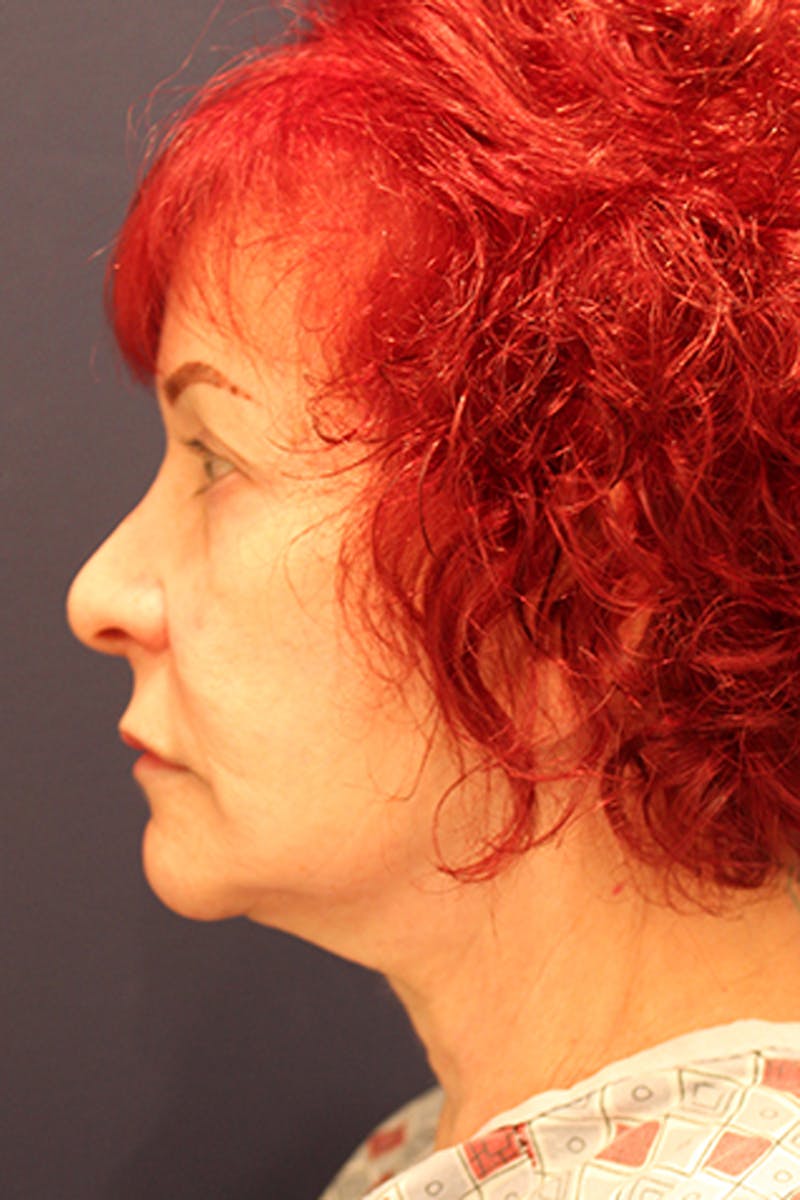 Rhinoplasty Before & After Gallery - Patient 174146512 - Image 5