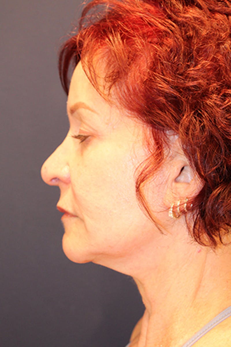 Rhinoplasty Before & After Gallery - Patient 174146512 - Image 6
