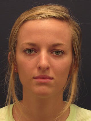 Rhinoplasty Before & After Gallery - Patient 174146517 - Image 2