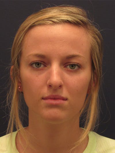 Rhinoplasty Before & After Gallery - Patient 174146517 - Image 2