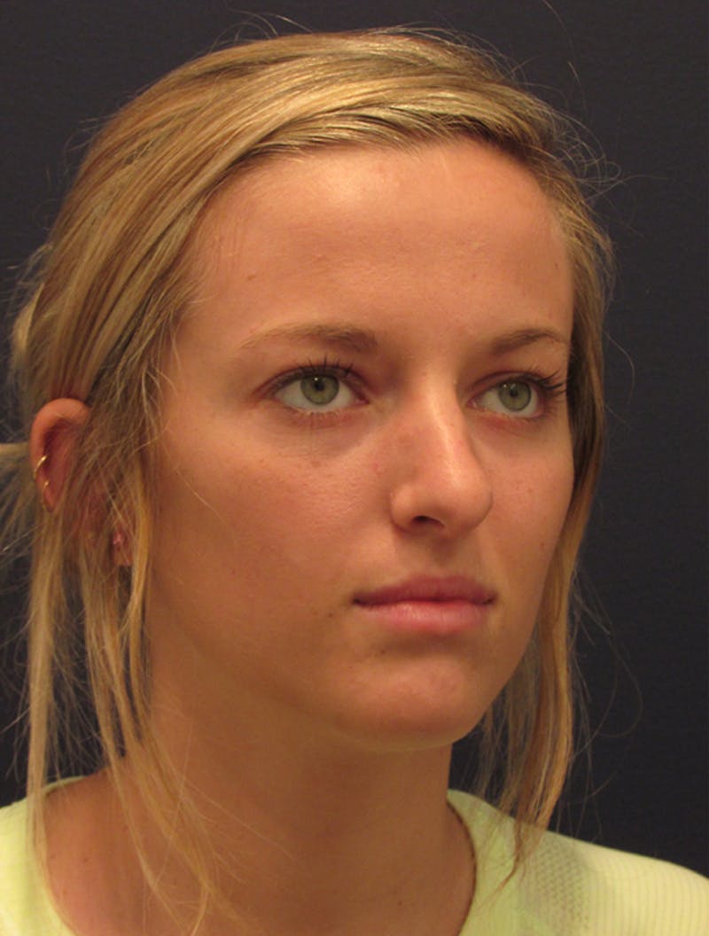 Rhinoplasty Before & After Gallery - Patient 174146517 - Image 4