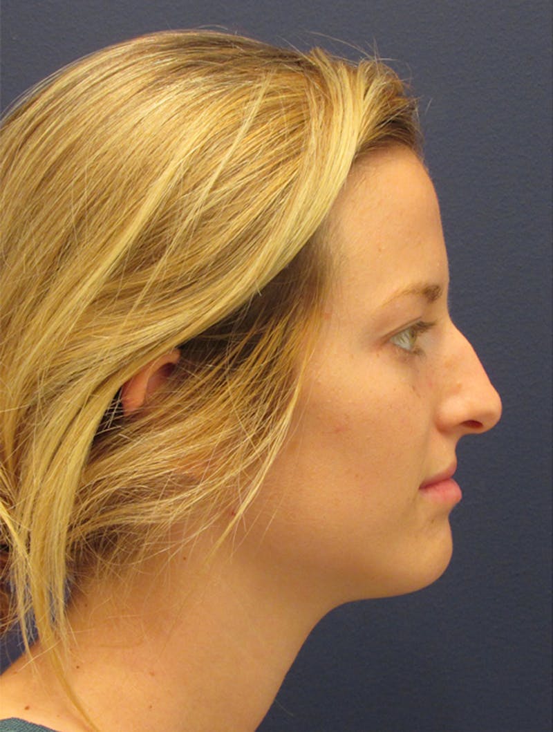 Rhinoplasty Before & After Gallery - Patient 174146517 - Image 5