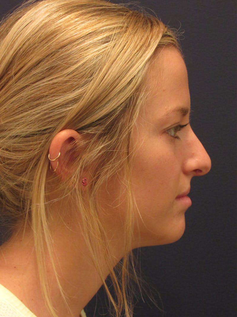 Rhinoplasty Before & After Gallery - Patient 174146517 - Image 6