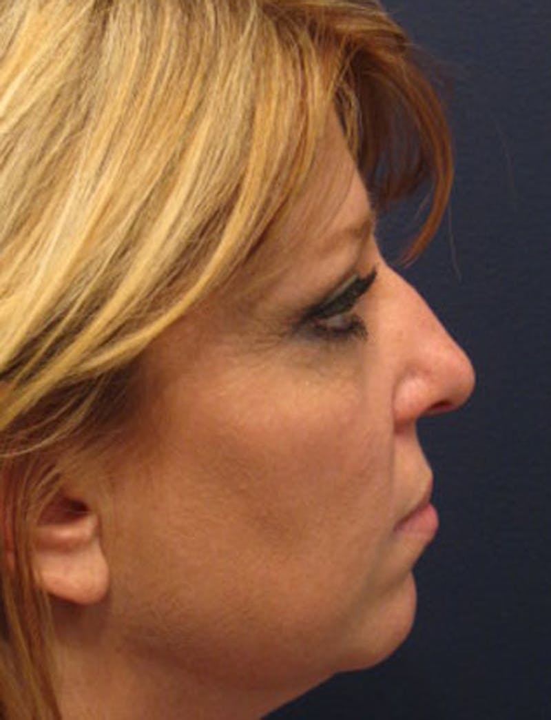 Rhinoplasty Before & After Gallery - Patient 174146523 - Image 5