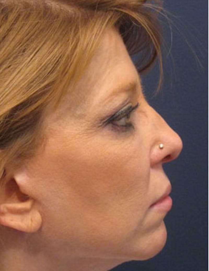 Rhinoplasty Before & After Gallery - Patient 174146523 - Image 6