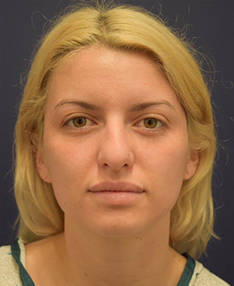 Rhinoplasty Before & After Gallery - Patient 174146527 - Image 1