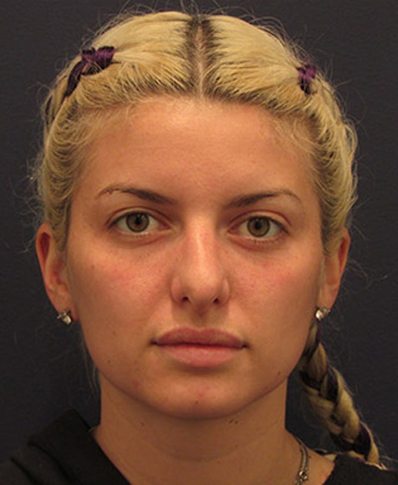Rhinoplasty Before & After Gallery - Patient 174146527 - Image 2