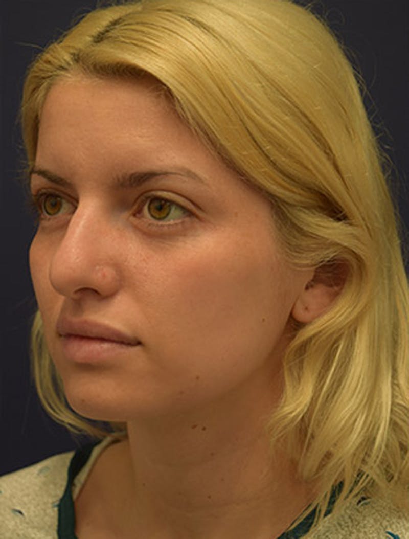 Rhinoplasty Before & After Gallery - Patient 174146527 - Image 3