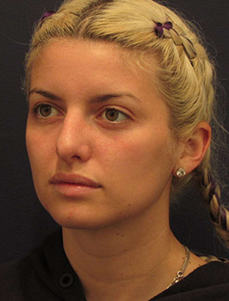Rhinoplasty Before & After Gallery - Patient 174146527 - Image 4