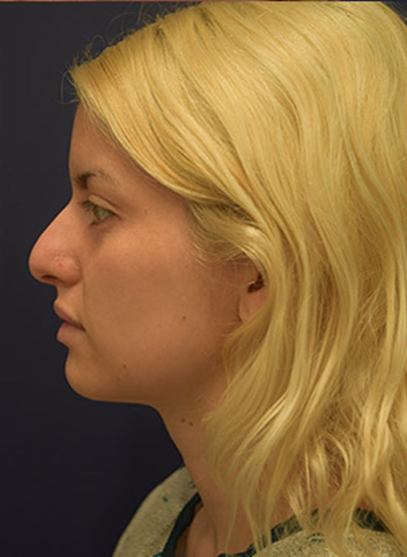 Rhinoplasty Before & After Gallery - Patient 174146527 - Image 5