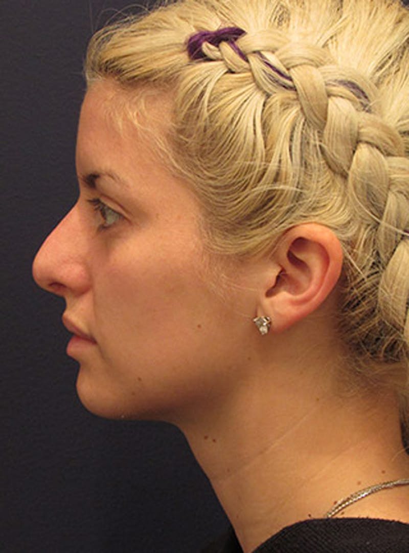 Rhinoplasty Before & After Gallery - Patient 174146527 - Image 6