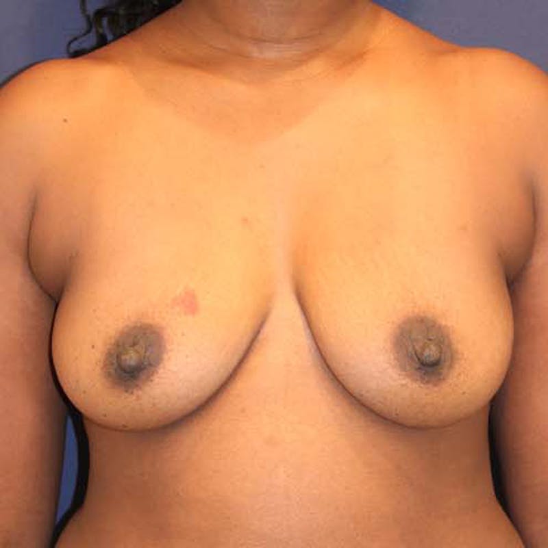 Breast Augmentation Before & After Gallery - Patient 174146560 - Image 1