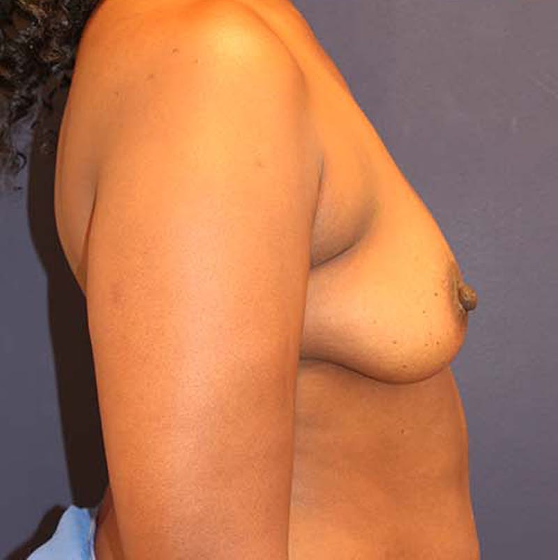 Breast Augmentation Before & After Gallery - Patient 174146560 - Image 5