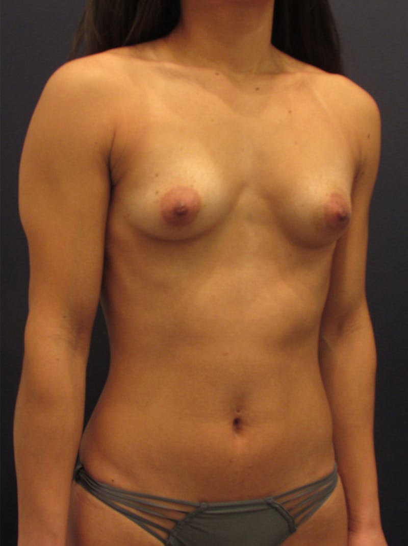Breast Augmentation Before & After Gallery - Patient 174146569 - Image 3