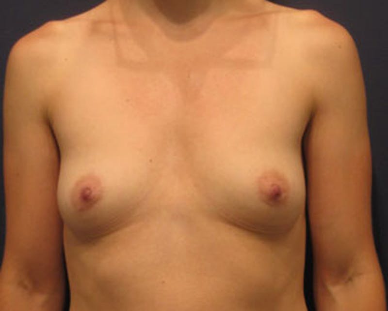 Breast Augmentation Before & After Gallery - Patient 174146573 - Image 1