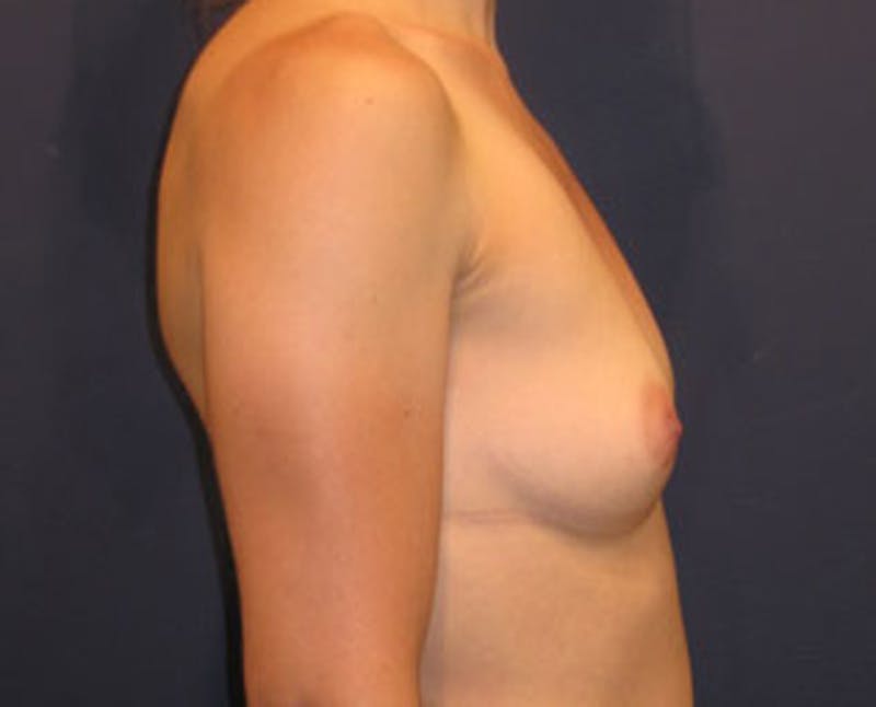 Breast Augmentation Before & After Gallery - Patient 174146573 - Image 5
