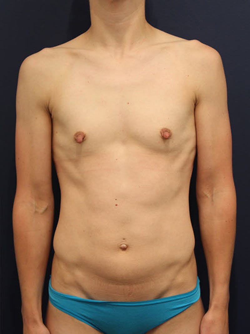 Breast Augmentation Before & After Gallery - Patient 174146578 - Image 1