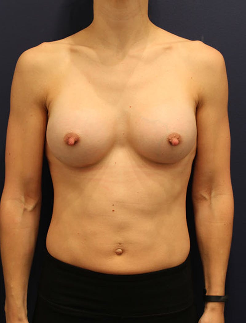 Breast Augmentation Before & After Gallery - Patient 174146578 - Image 2