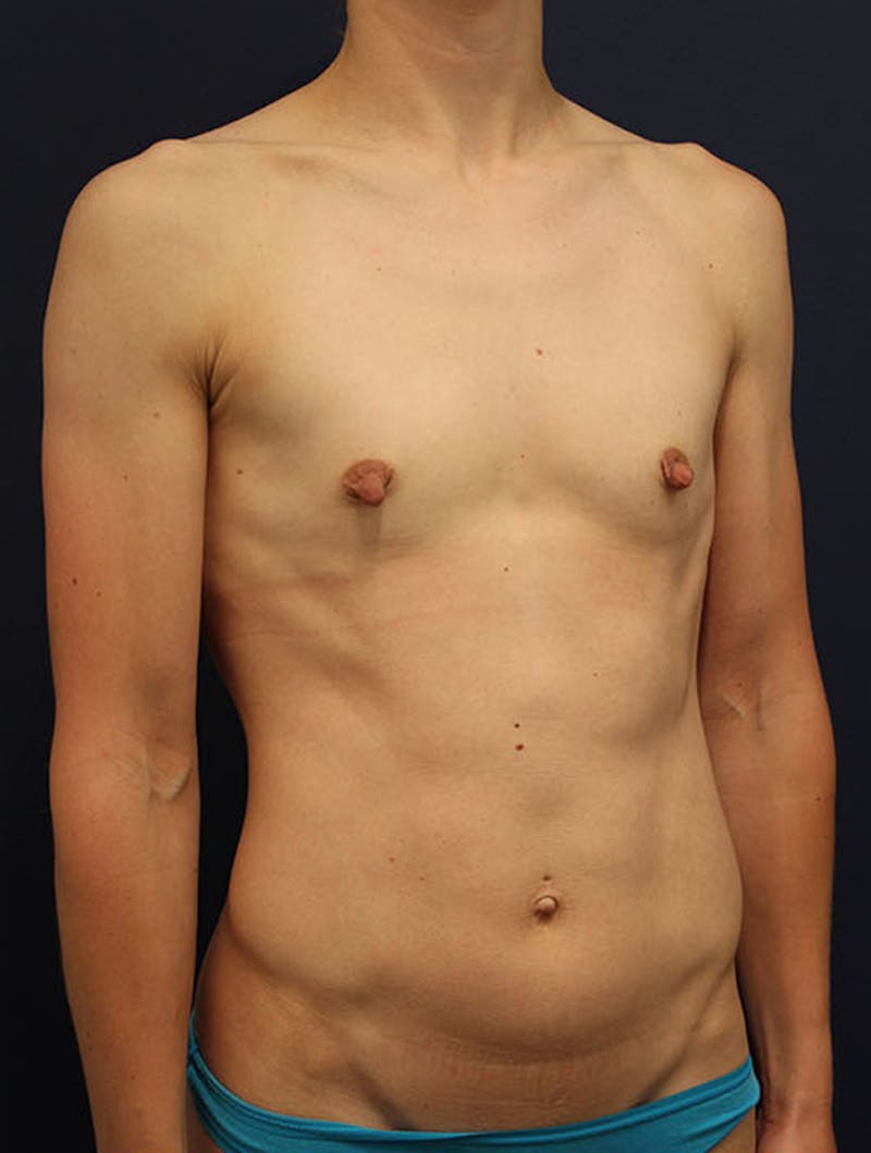 Breast Augmentation Before & After Gallery - Patient 174146578 - Image 3