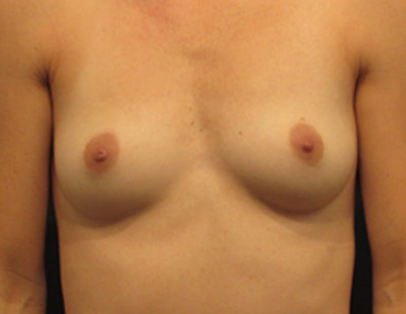 Breast Augmentation Before & After Gallery - Patient 174146590 - Image 1