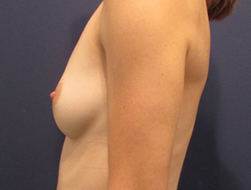 Breast Augmentation Before & After Gallery - Patient 174146590 - Image 5