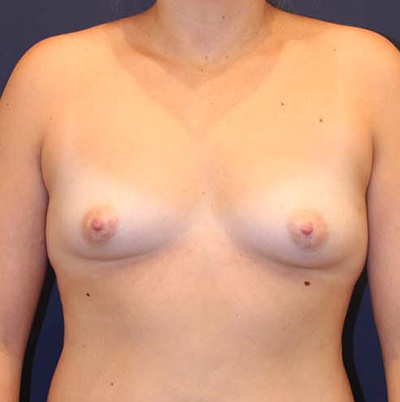 Breast Augmentation Before & After Gallery - Patient 174146601 - Image 1