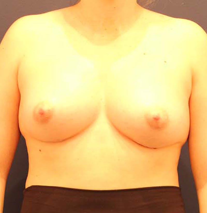 Breast Augmentation Before & After Gallery - Patient 174146601 - Image 2