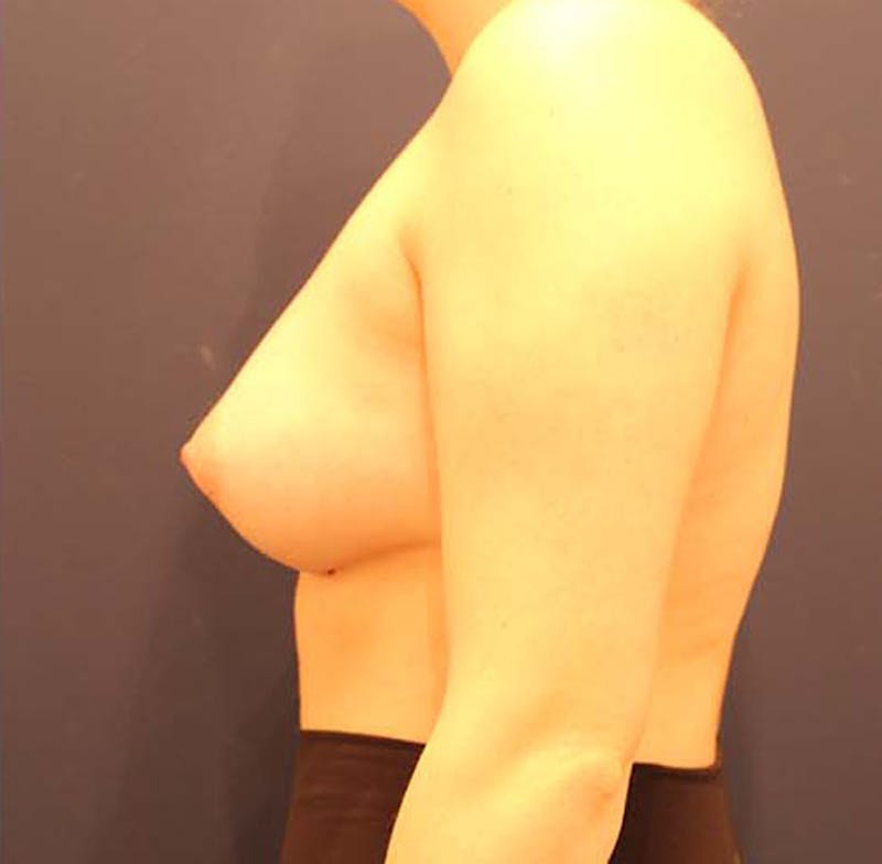 Breast Augmentation Before & After Gallery - Patient 174146601 - Image 6
