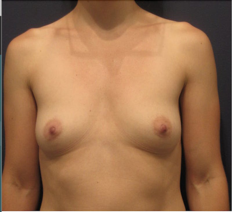 Breast Augmentation Before & After Gallery - Patient 174146614 - Image 1
