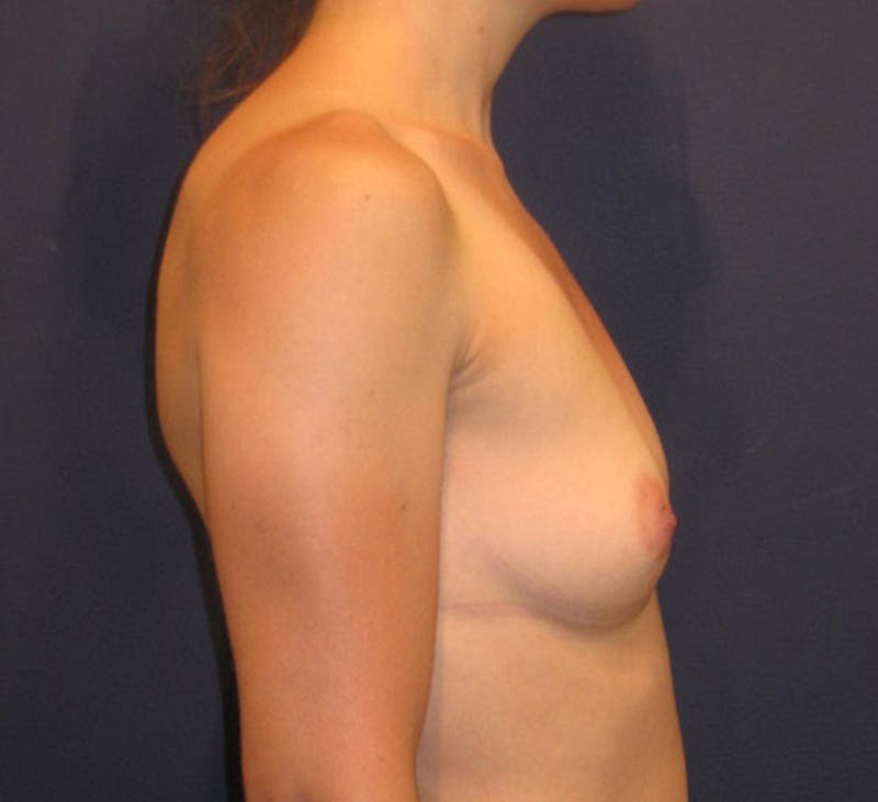 Breast Augmentation Before & After Gallery - Patient 174146614 - Image 5