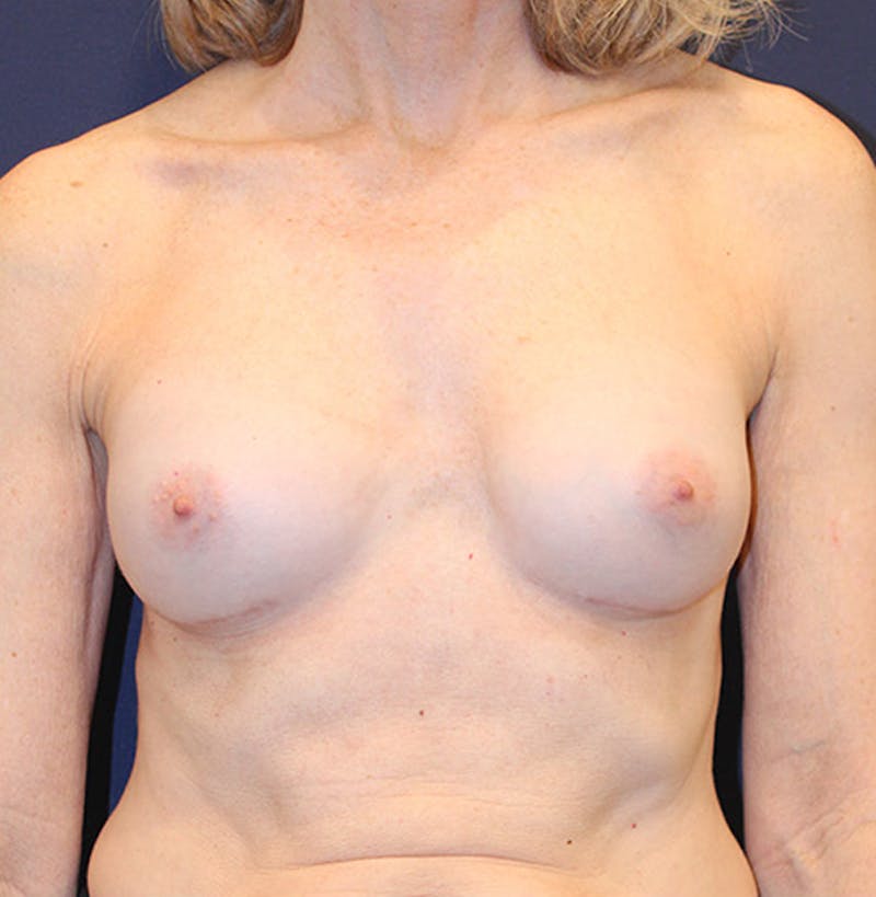 Breast Augmentation Before & After Gallery - Patient 174146622 - Image 2