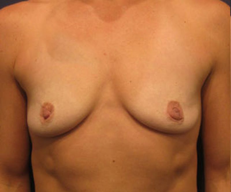 Breast Augmentation Before & After Gallery - Patient 174147704 - Image 1