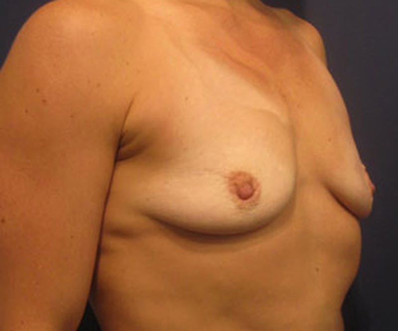 Breast Augmentation Before & After Gallery - Patient 174147704 - Image 3