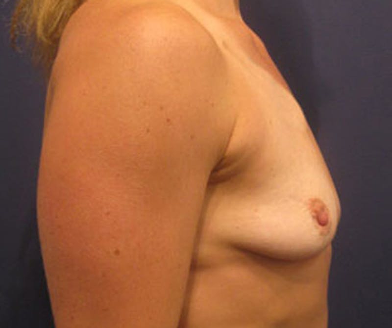 Breast Augmentation Before & After Gallery - Patient 174147704 - Image 5