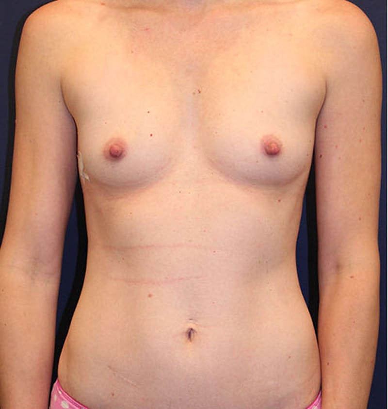 Breast Augmentation Before & After Gallery - Patient 174147710 - Image 1