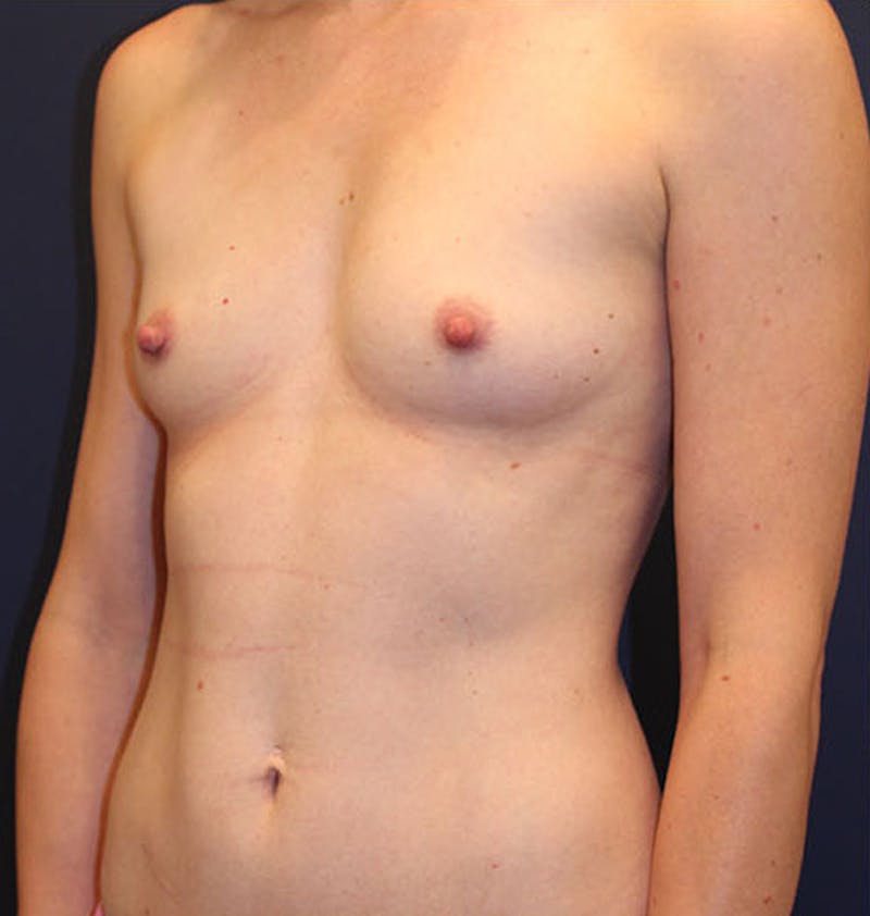 Breast Augmentation Before & After Gallery - Patient 174147710 - Image 3