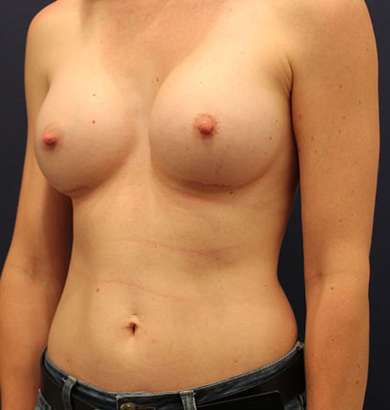 Breast Augmentation Before & After Gallery - Patient 174147710 - Image 4