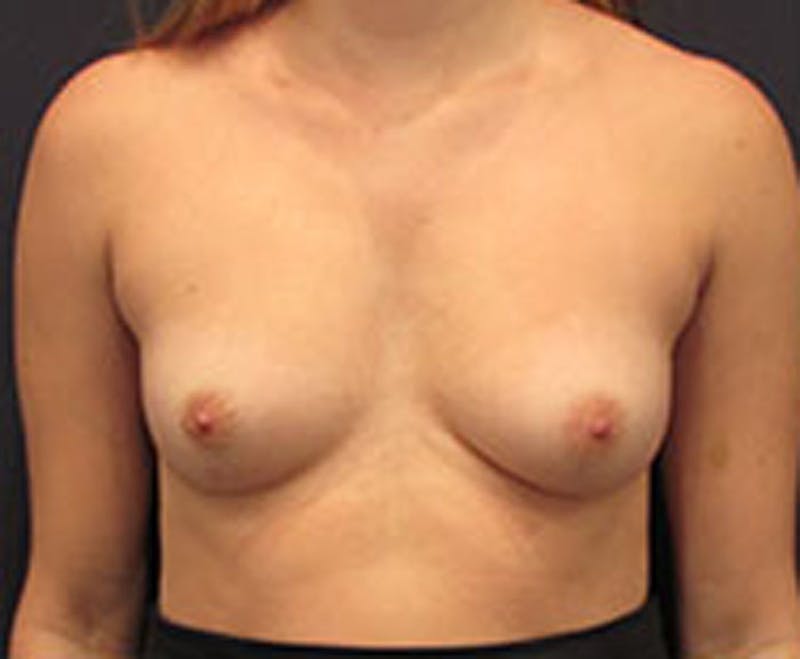 Breast Augmentation Before & After Gallery - Patient 174147715 - Image 1