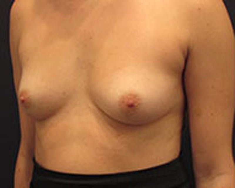 Breast Augmentation Before & After Gallery - Patient 174147715 - Image 3
