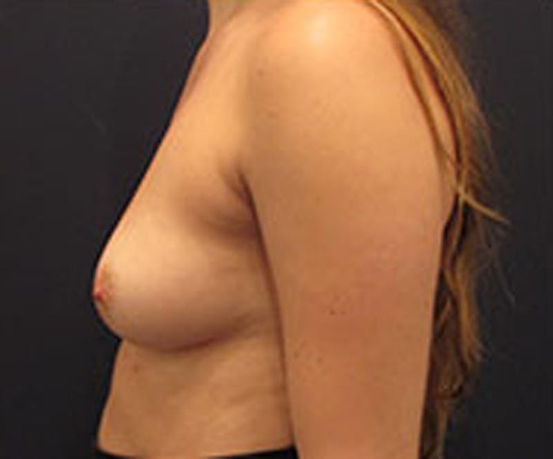 Breast Augmentation Before & After Gallery - Patient 174147715 - Image 5