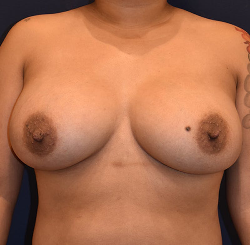 Breast Augmentation Before & After Gallery - Patient 174147791 - Image 2