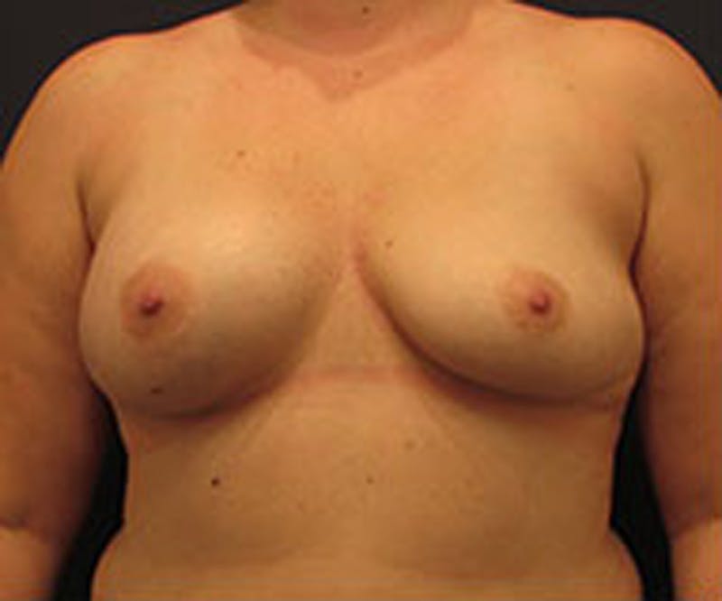 Breast Augmentation Before & After Gallery - Patient 174148875 - Image 1