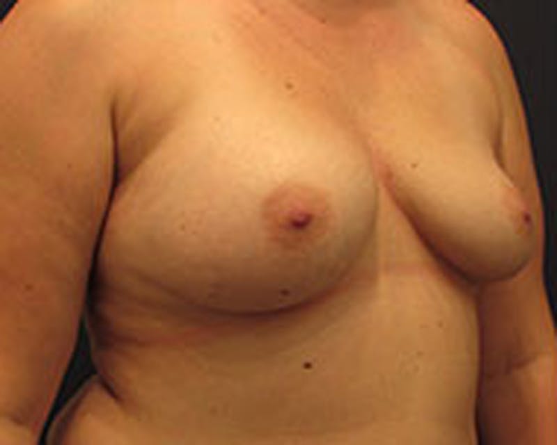 Breast Augmentation Before & After Gallery - Patient 174148875 - Image 3