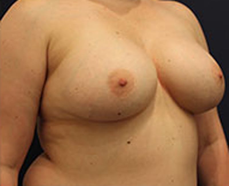 Breast Augmentation Before & After Gallery - Patient 174148875 - Image 4