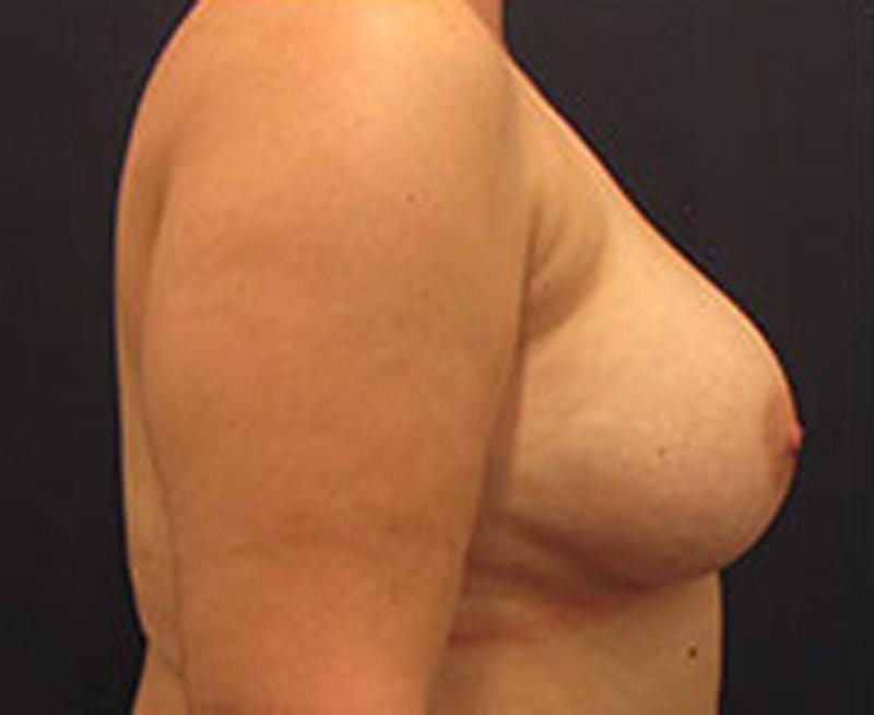Breast Augmentation Before & After Gallery - Patient 174148875 - Image 5