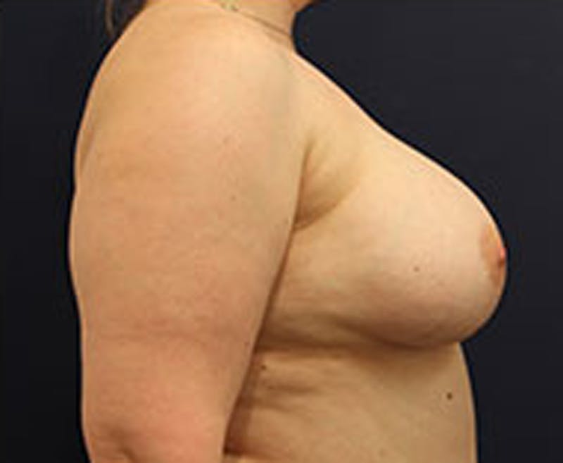 Breast Augmentation Before & After Gallery - Patient 174148875 - Image 6