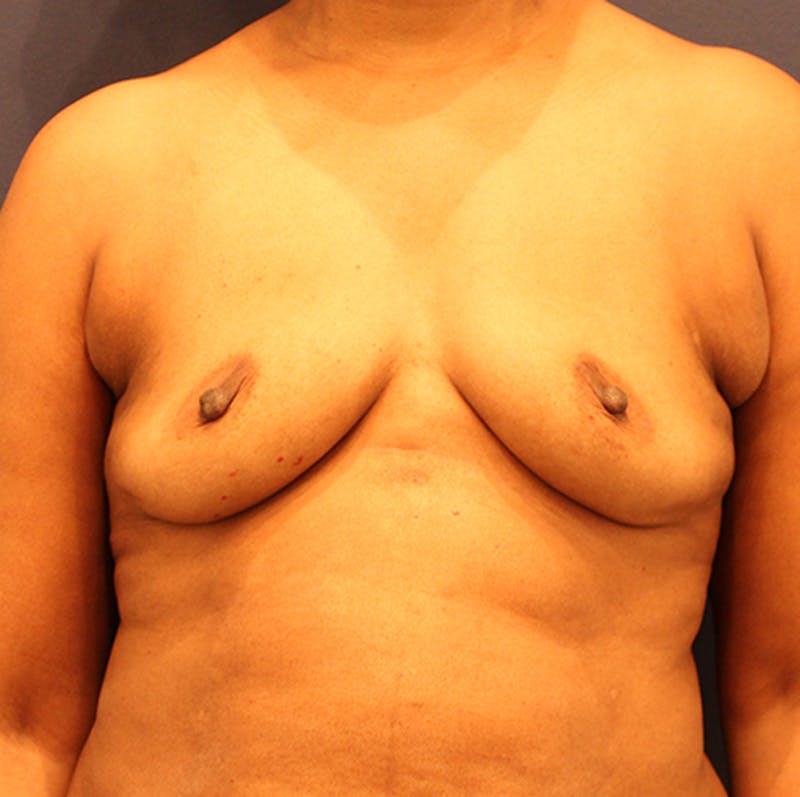 Breast Augmentation Before & After Gallery - Patient 174149971 - Image 1