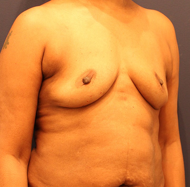 Breast Augmentation Before & After Gallery - Patient 174149971 - Image 3