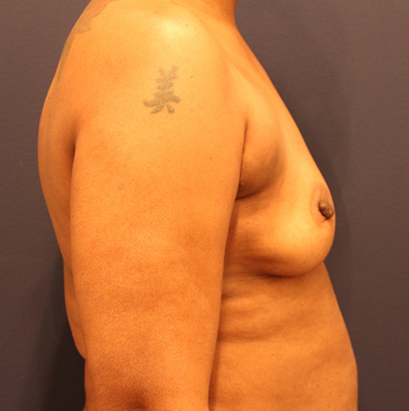Breast Augmentation Before & After Gallery - Patient 174149971 - Image 5