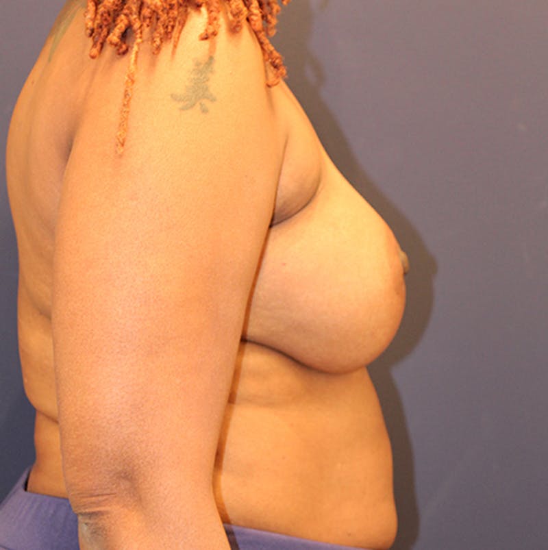 Breast Augmentation Before & After Gallery - Patient 174149971 - Image 6